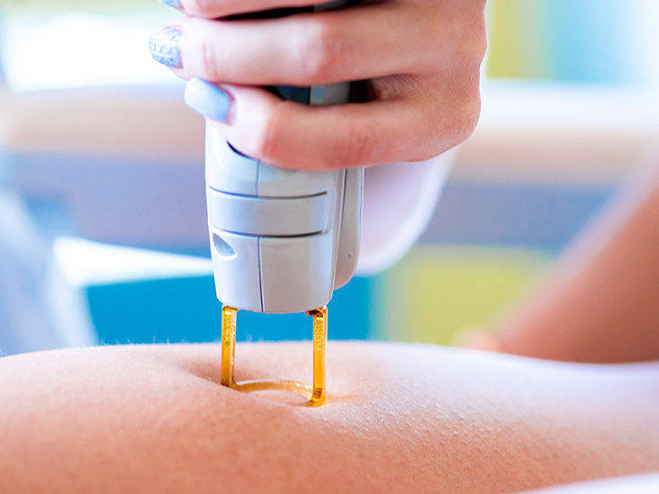 Description of Laser Hair Removal Technology Options for Clinics